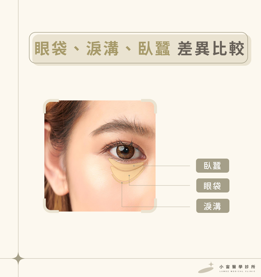 眼袋 淚溝 臥蠶差異比較