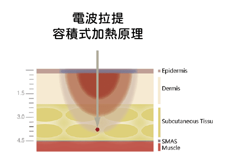 電波拉提 