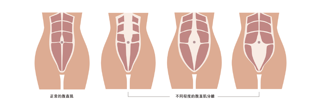 cmslim,增肌減脂,黑科技健身,腹肌,馬甲線,產後,產後腹直肌