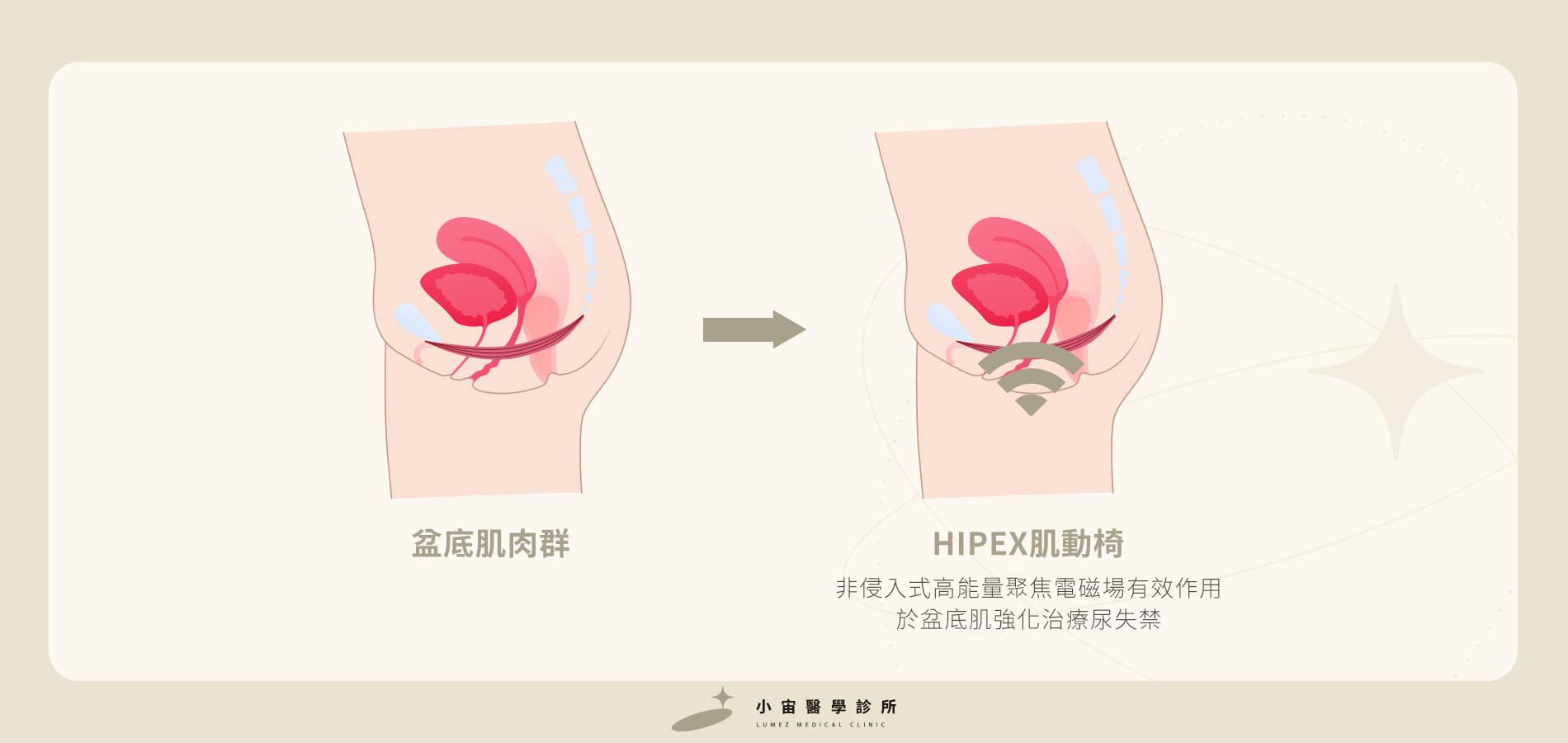 小宙_CMSlim HIPEX肌動椅_如何改善骨盆肌問題1