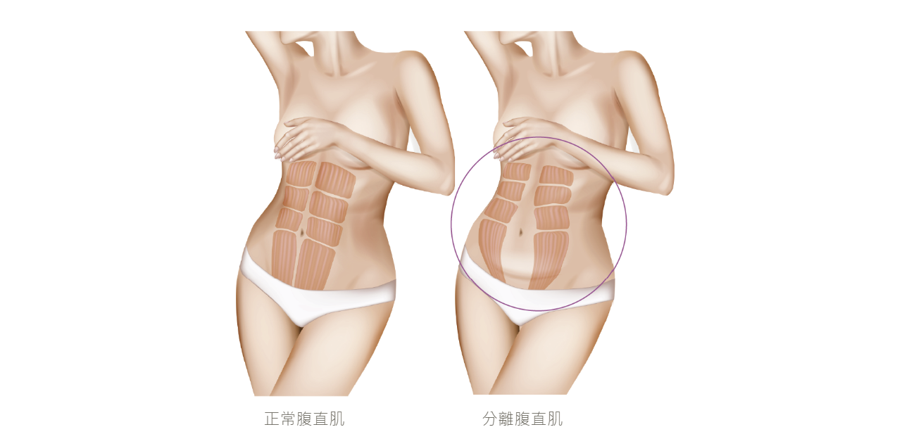 cmslim,增肌減脂,黑科技健身,腹肌,馬甲線,產後,產後腹直肌
